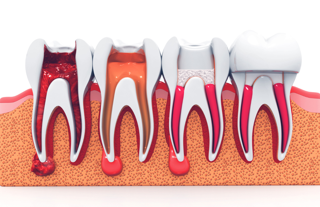 Root Canal Therapy illustration