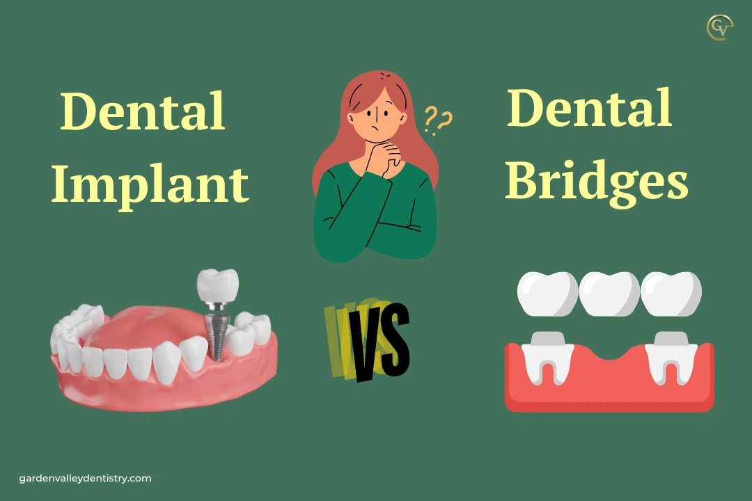 Dental Implant vs DEntal Bridges