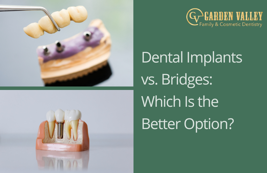 Dental Implants vs. Bridges: Which Is the Better Option?