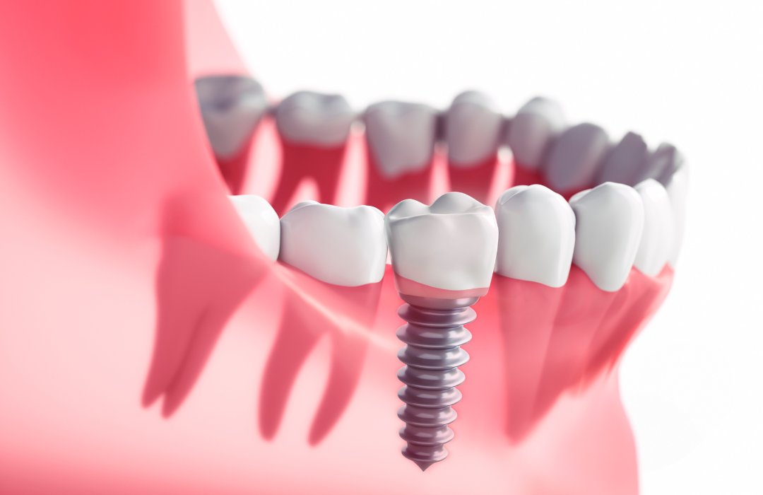 Dental Implants by Garden Valley Family & Cosmetic Dentistry