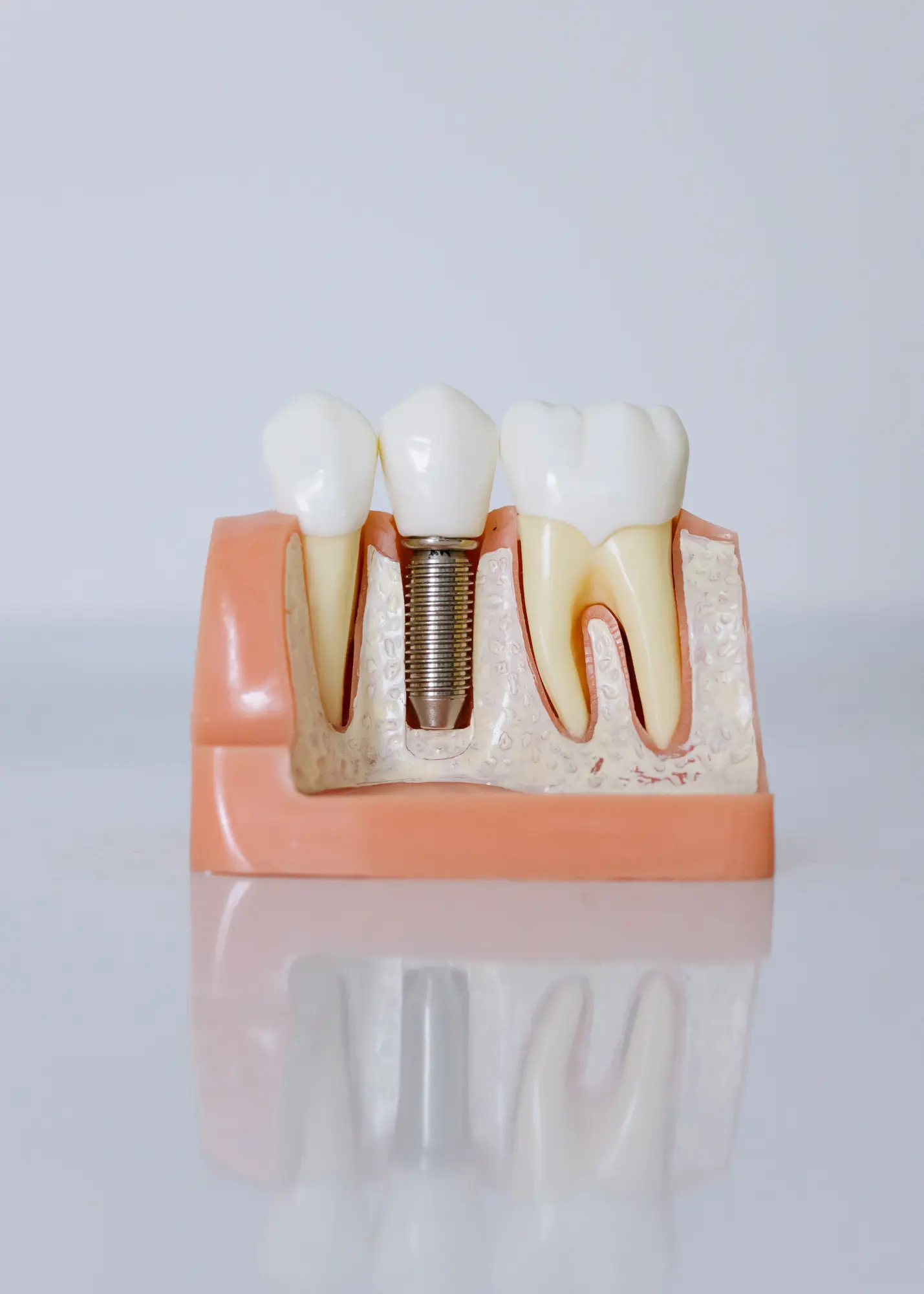 Garden Valley Family & Cosmetic Dentistry's Dental Implant service