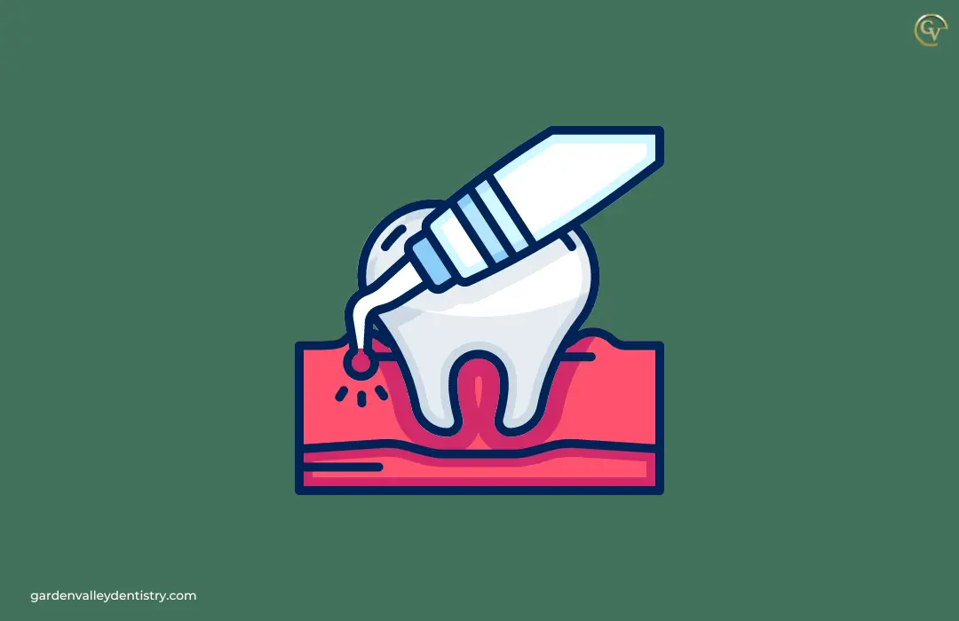 Scaling and Root Planing