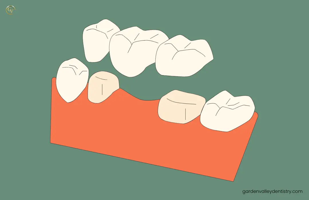 Dental Bridges Dental bridges by GVD