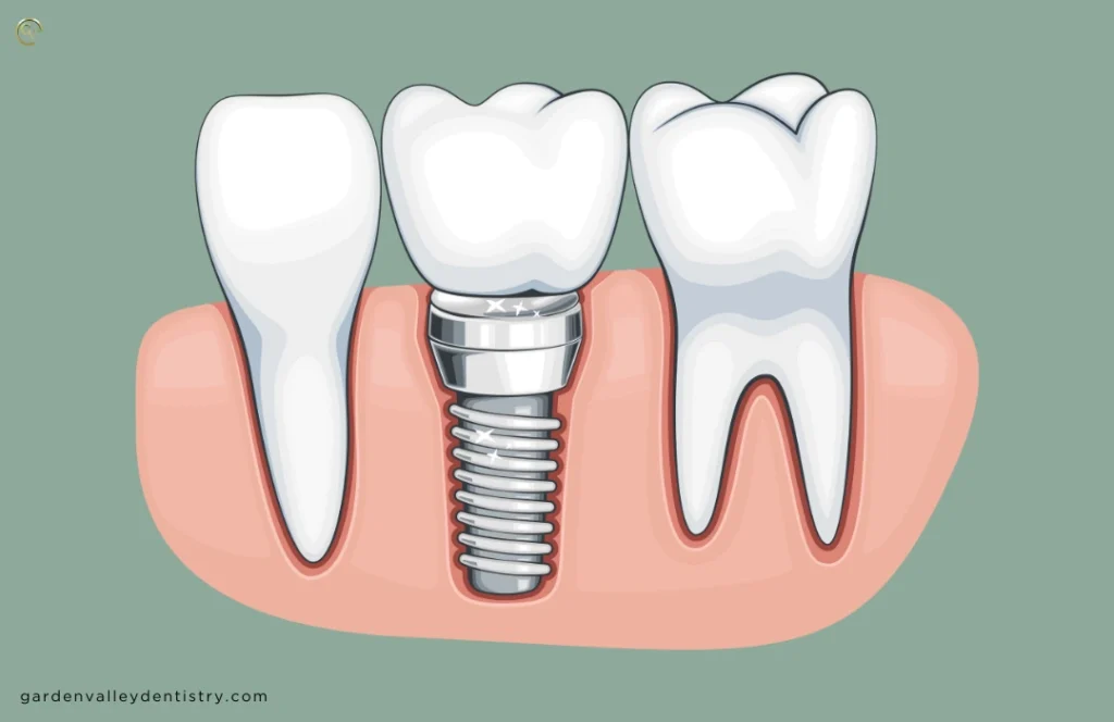 How Much Are Dental Implants? by Garden Valley Dentistry