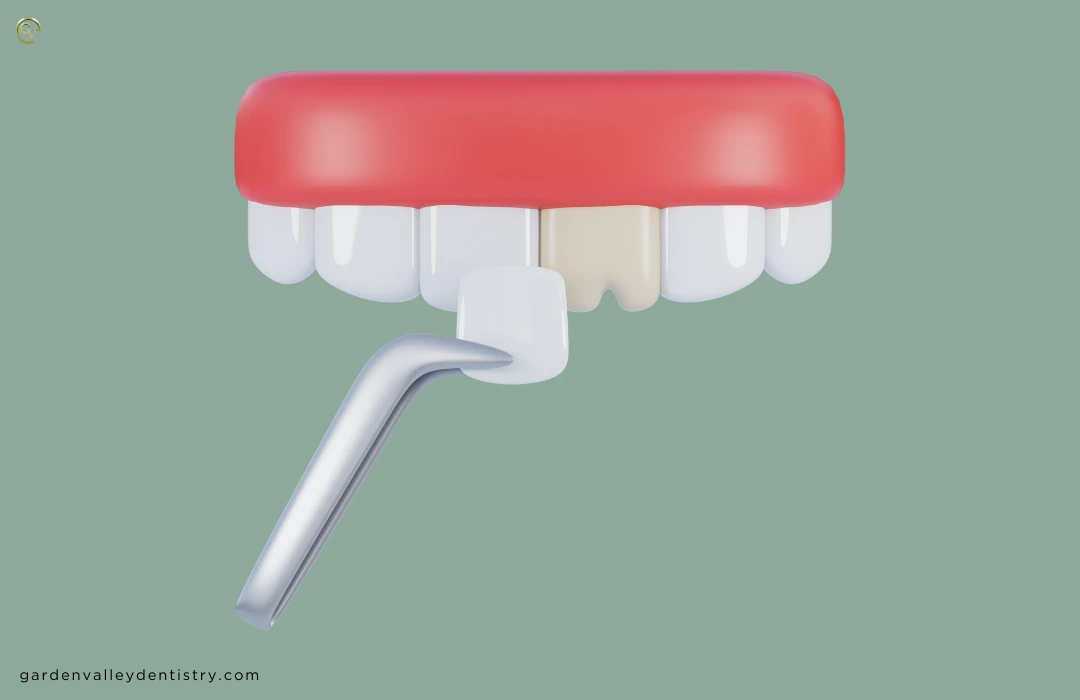 How Much Are Veneers? in Garden Valley Dentistry