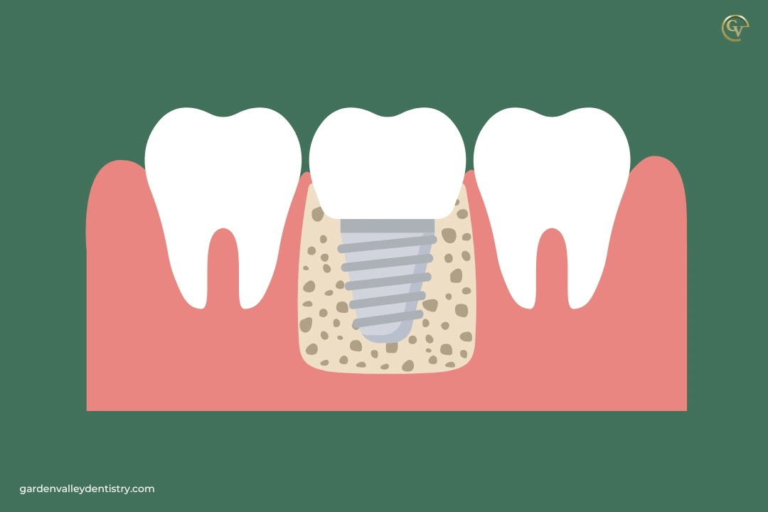 Benefits of Dental Implants