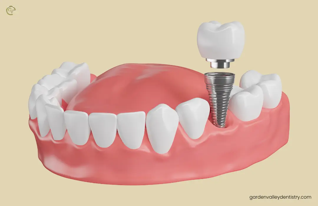 Dental Implants
