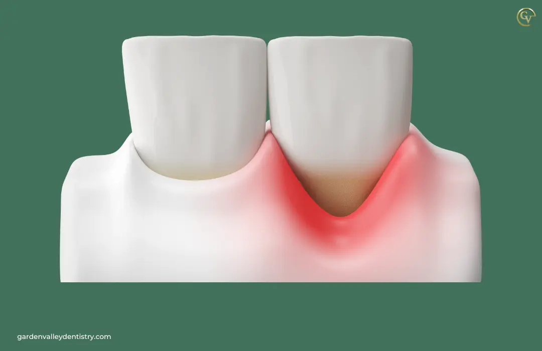 How Long Does Gum Treatment Take to Heal