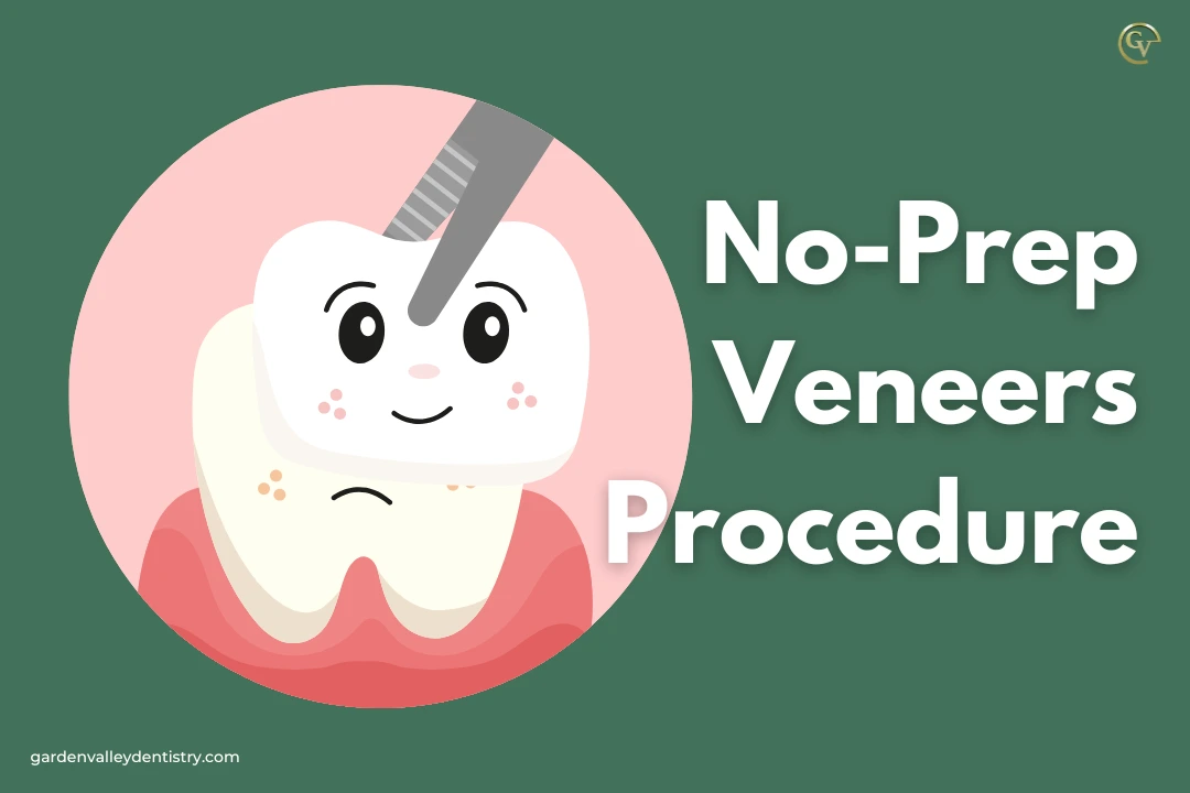 No-Prep Veneers: A Conventional Approach to a Perfect Smile