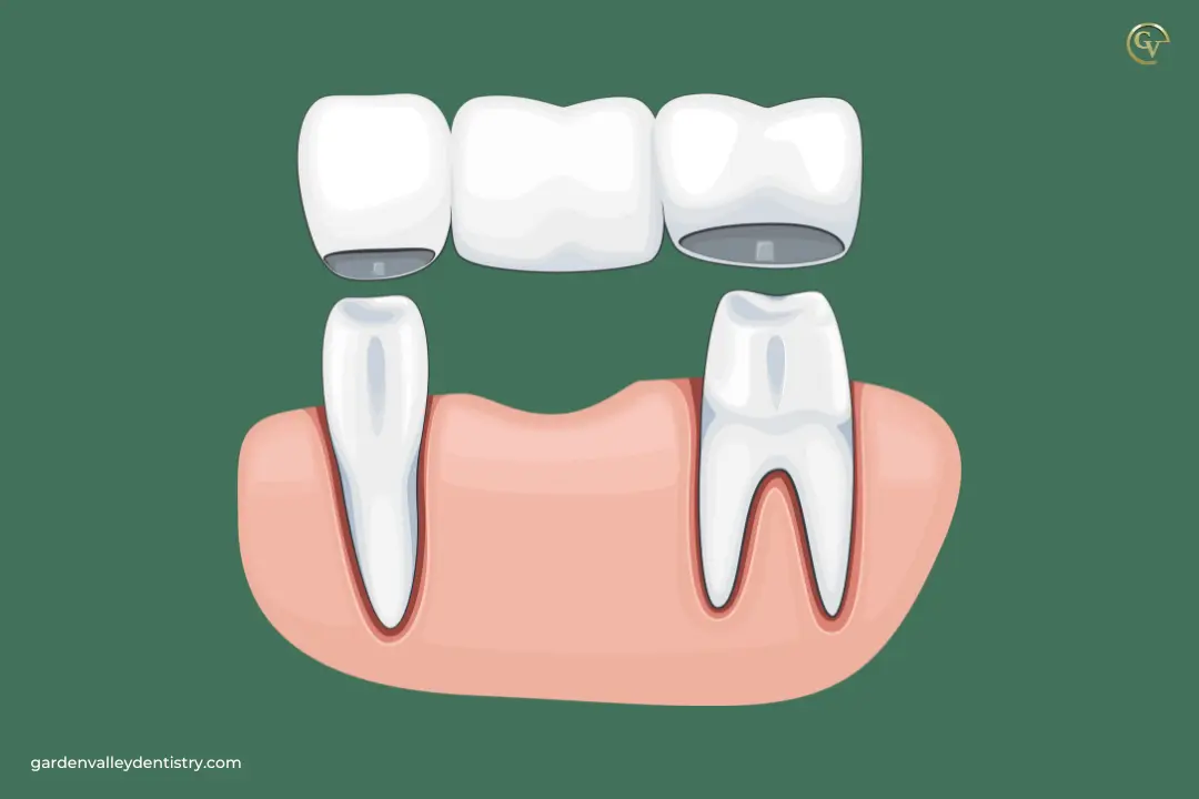 Which Dental Treatment is Best