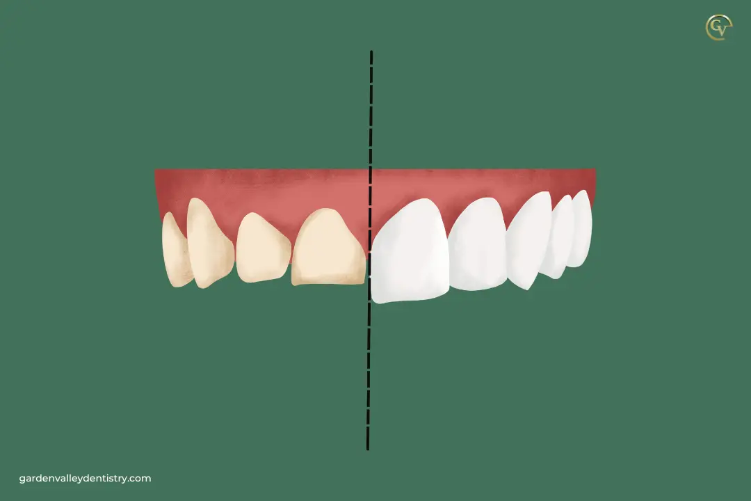 Which Dental Treatment is Best