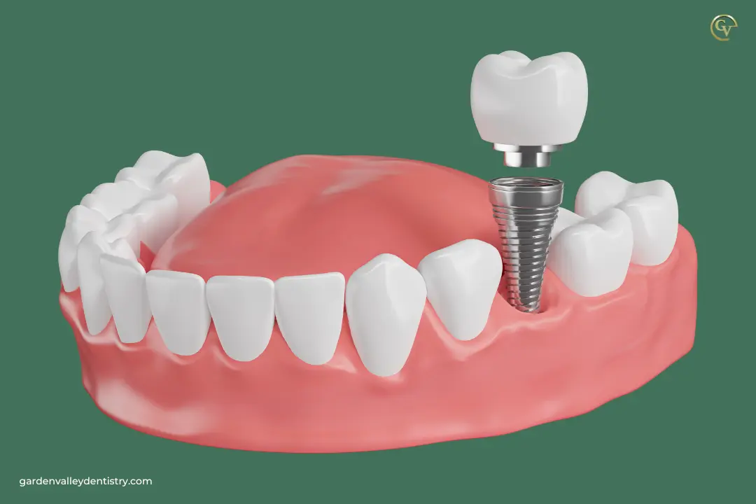 Which Dental Treatment is Best