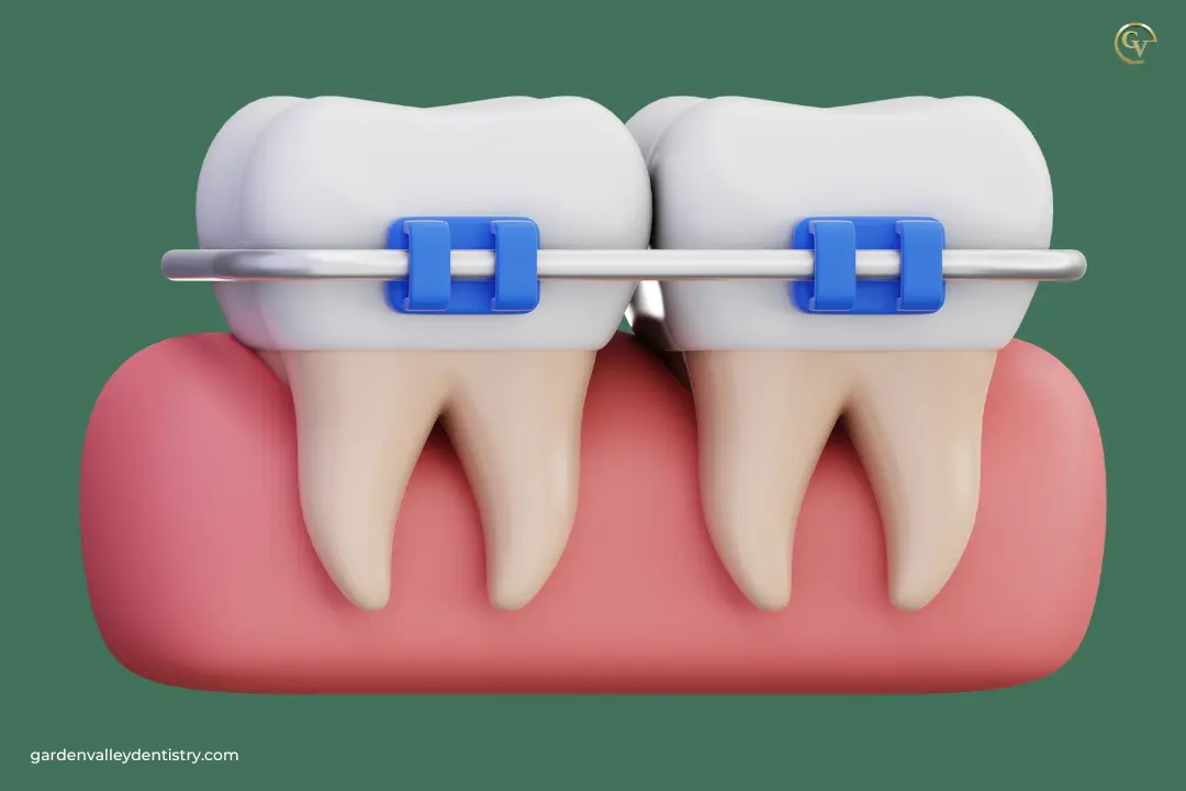 Which Dental Treatment is Best