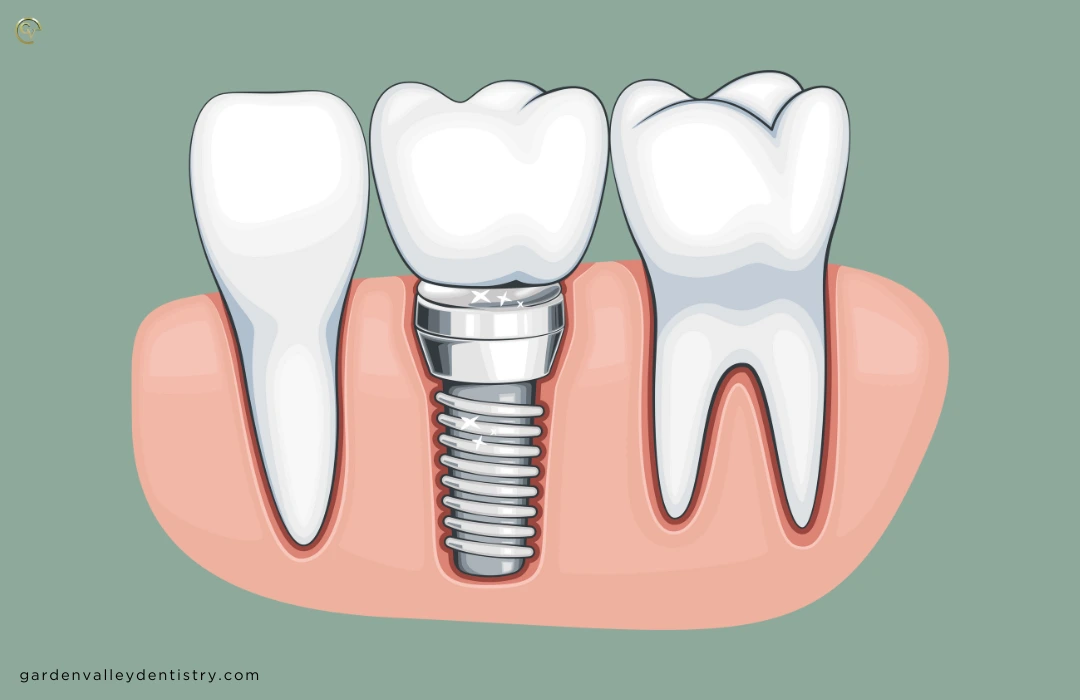 Dental implants