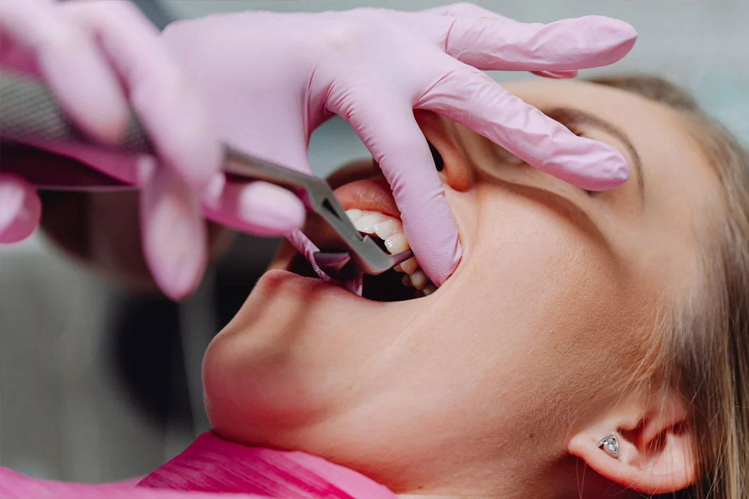 teeth extraction Teeth extraction